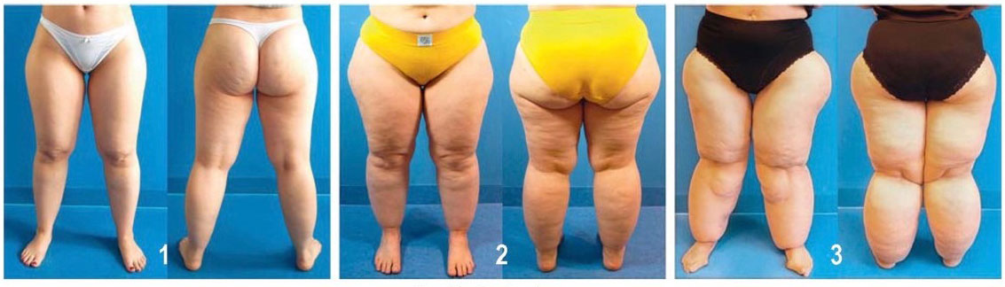 Lipödem Sınıflaması